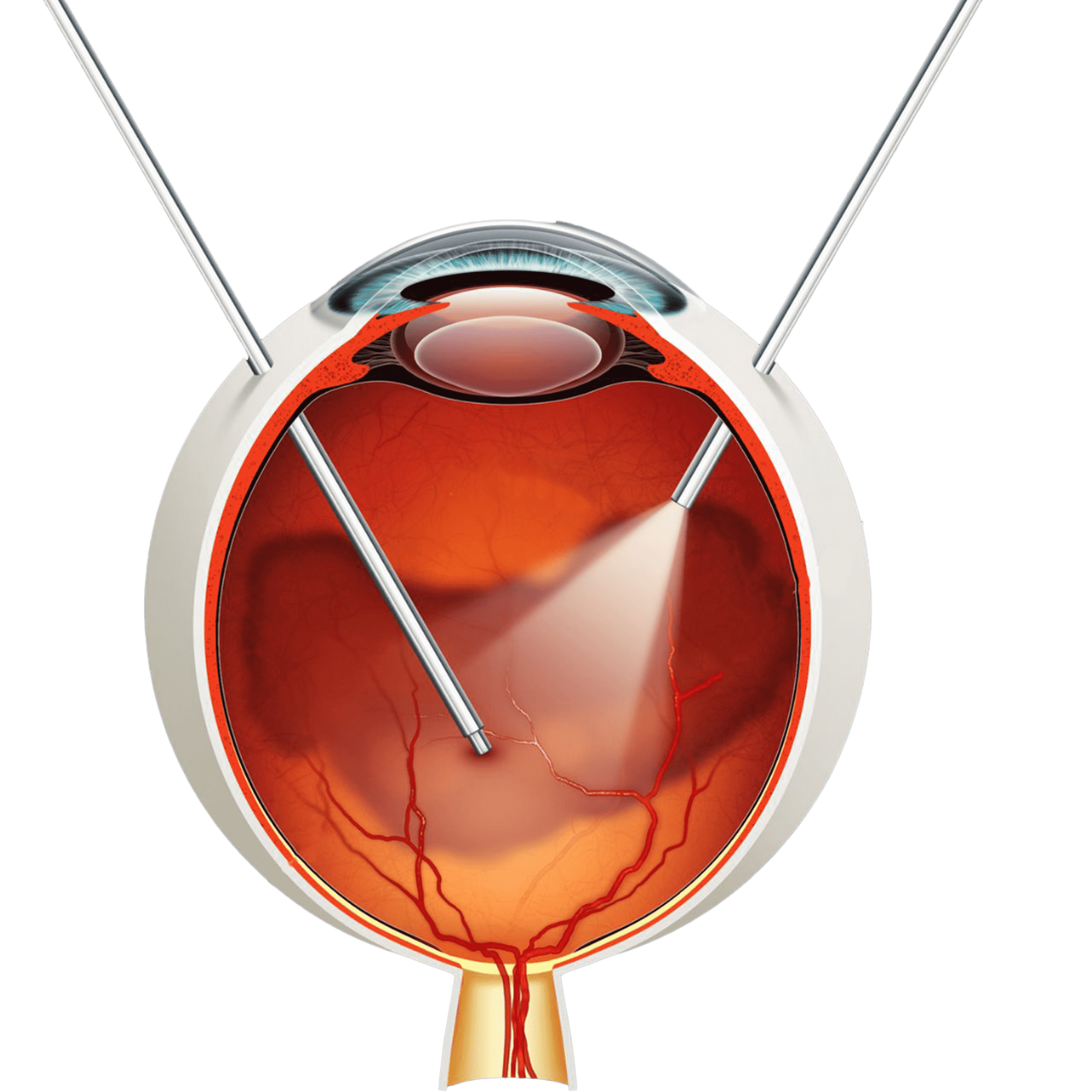 Vitrektomi<br>operasyonu<br>nedir ?