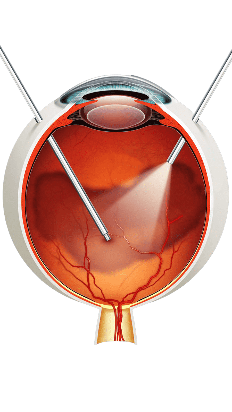 Vitrektomi<br>operasyonu<br>nedir ?