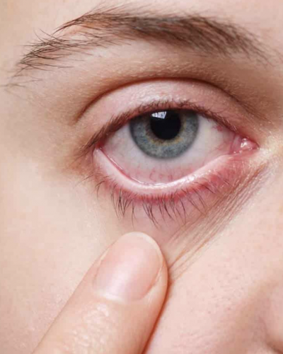 How long can you wait before seeing a doctor for eye infections (conjunctivitis)?