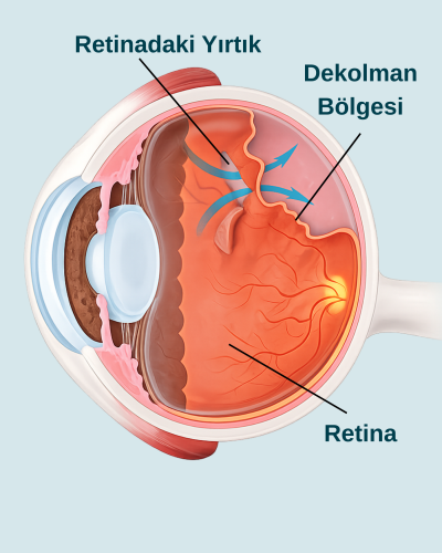 Retina Dekolmanı Nedir? Neden Acil Müdahale Gerektirir?